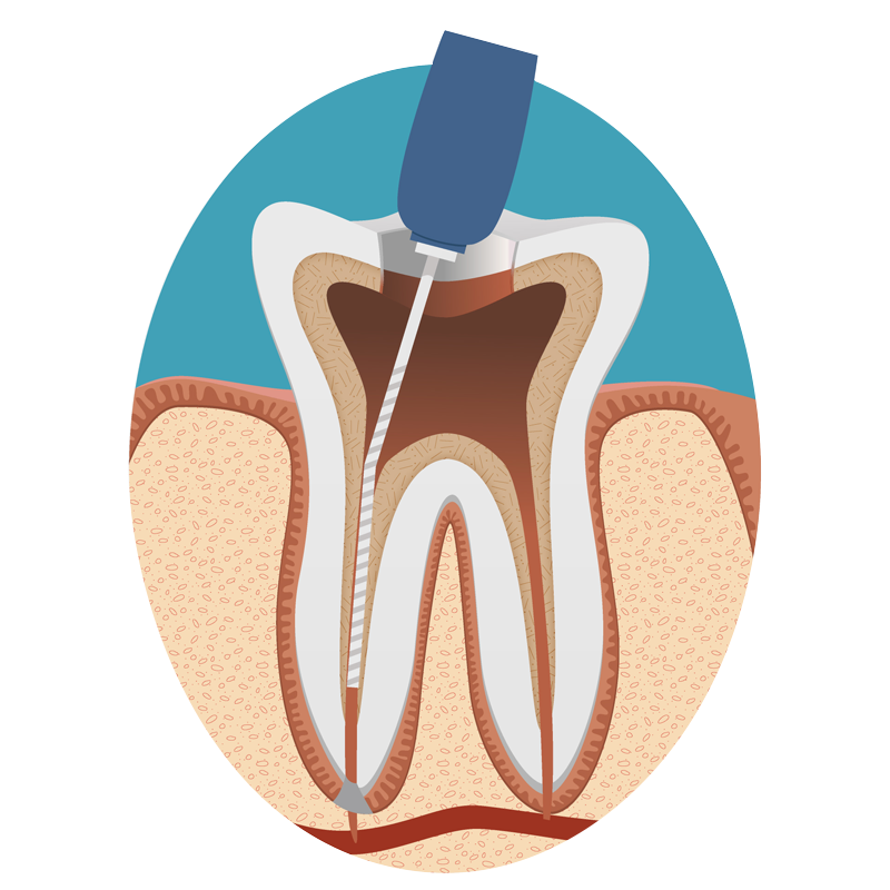 歯内（歯髄＝歯の神経）治療