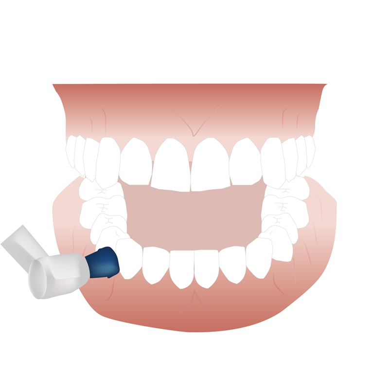 PMTC・歯の徹底クリーニング